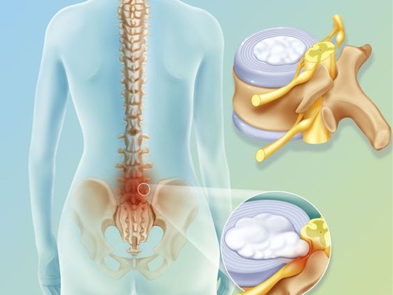 فیزیوتراپی دیسک کمر
