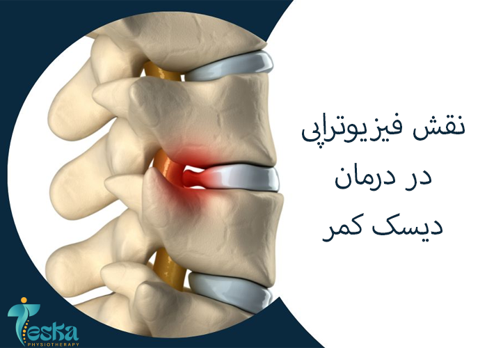 نقش فیزیوتراپی در درمان دیسک کمر