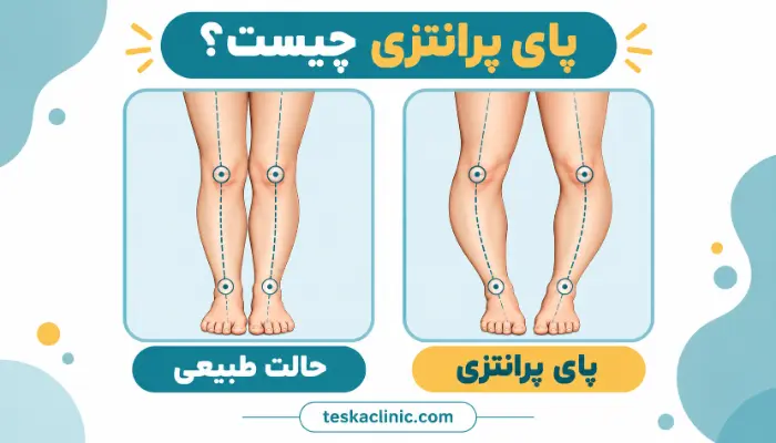 مقایسه راستای طبیعی پا و پای پرانتزی از نمای جلو