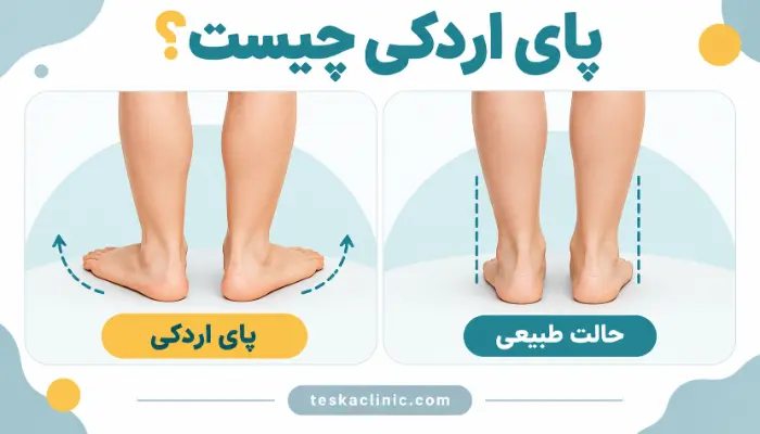 مقایسه پای اردکی با حالت طبیعی پا از نمای پشت