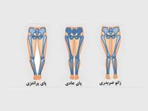 درمان و اصلاح راه رفتن با فیزیوتراپی - پای اردکی و پرانتزی