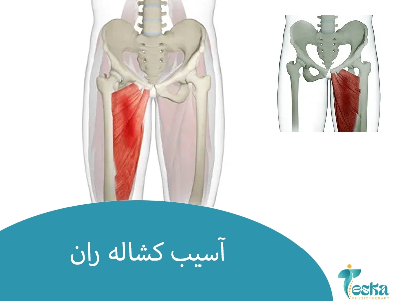 آسیب کشاله ران