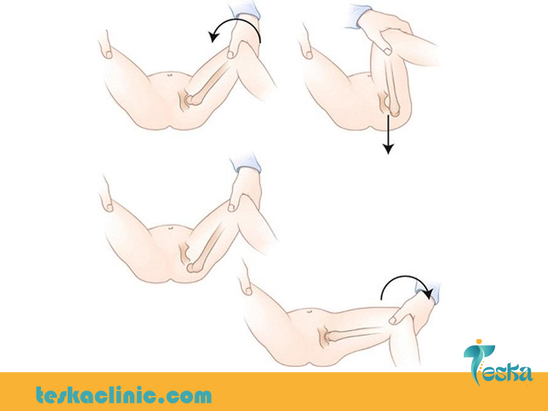 تاثیر فیزیوتراپی در دررفتگی مادرزادی لگن