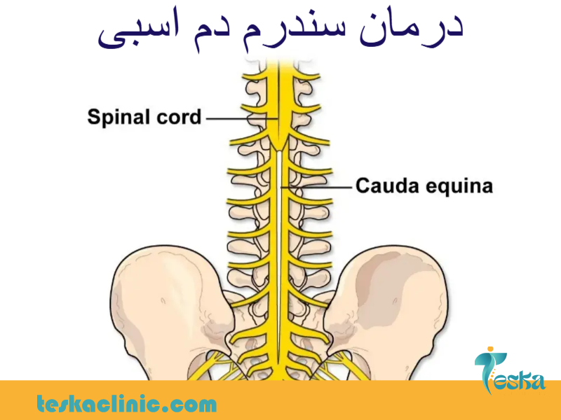 درمان سندروم دم اسبی