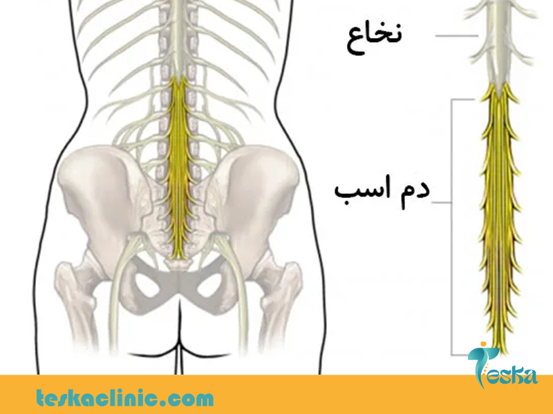 سندروم دم اسبی