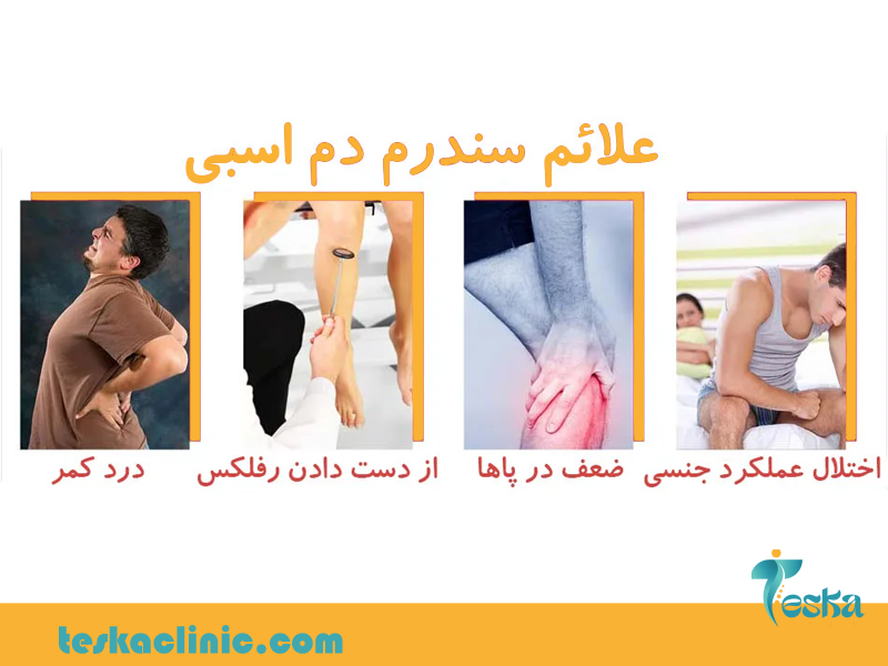 علائم سندروم دم اسبی